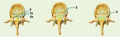 Decision Making in Patients With Metastatic Spine. The Role of Minimally Invasive Treatment Modalities